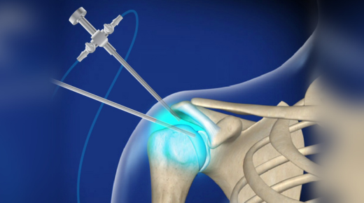 Arthroscopic Shoulder Surgery Settlements - What You Need to Know