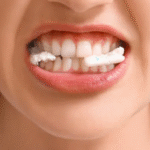 xylitol chewing gum