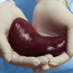 Best kidney transplant hospital in bangalore
