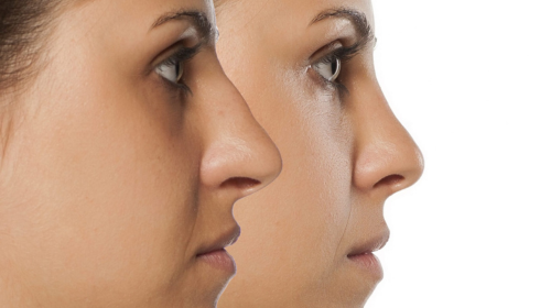 best rhinoplasty surgeon in bangalore
