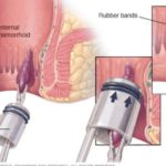 hemorrhoid treatment
