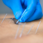 Dry needling therapy