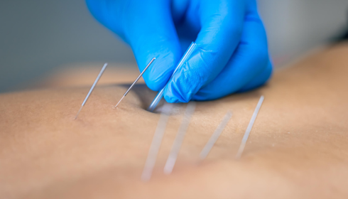 Dry needling therapy