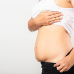 weight-loss tummy tuck