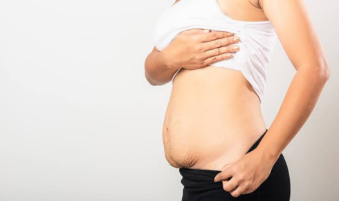 weight-loss tummy tuck