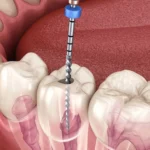 a root canal treatment in Scarborough