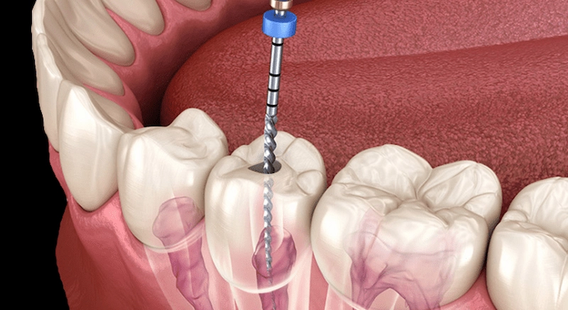 a root canal treatment in Scarborough
